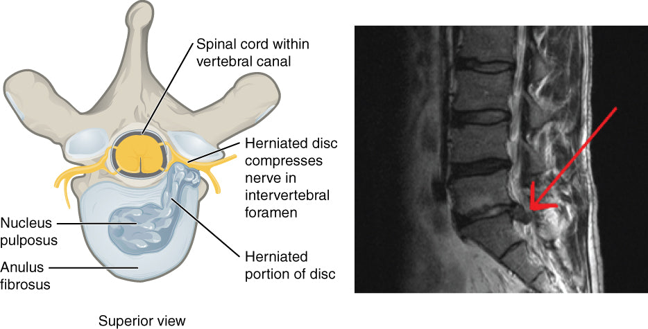 Anatomical diagram of a herniated disc and an MRI of the lower spine